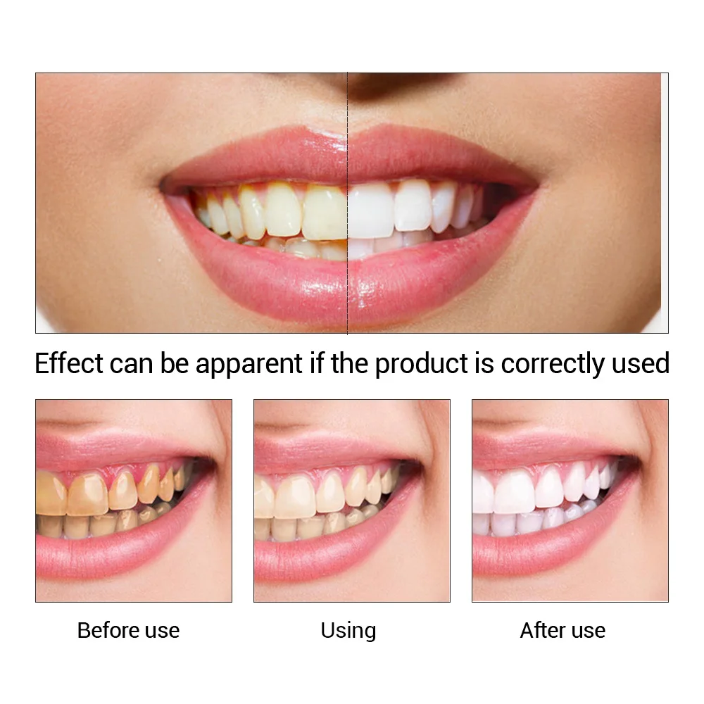 FTEENPLY diş beyazlatma özü to - Teeth Whitening Diy incelemesi ve fiyatı