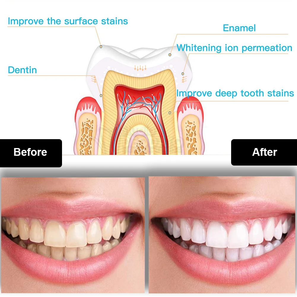 Diş Diş Beyazlatma Kiti Mini 1 - Teeth Whitening With Peroxide incelemesi ve fiyatı